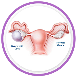 Ovarian Cyst