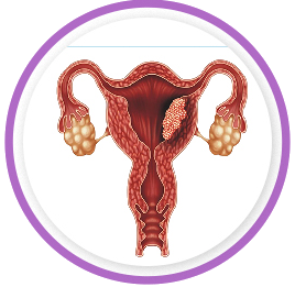 Uterine Cancer