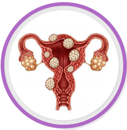 Uterine Fibroid