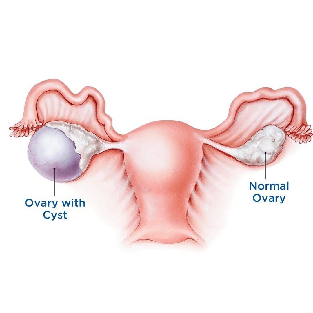 Who Is Affected by Ovarian Cysts?
